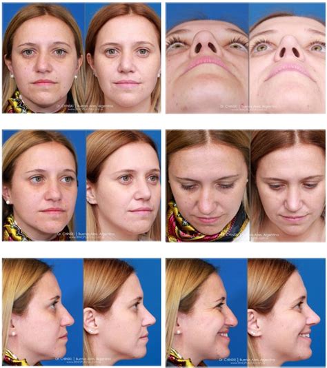 nasal tip contour  support management rhinoplasty archive