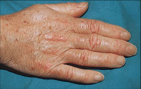 Gottron sign: symmetric violaceous erythema overlying the dorsal aspect ...