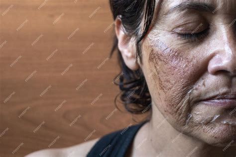 O Que Passar No Rosto Queimado Do Sol - Mulher com queimaduras químicas no rosto após passar por um peeling ...
