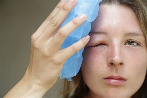 Swollen Lower Eyelid