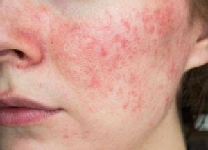 sensitive  reactive skin  skin care clinic