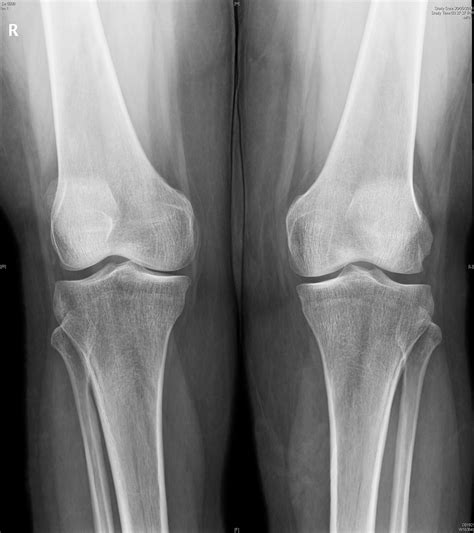 Joint Replacements Gallery - DOCJOINTS//DR SUJIT JOS//Total joint