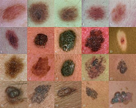 Pinta Preta Na Pele Aparece De Repente - Fotos De Melanoma Muito Precoce Pintas Pretas Na Pele: Sinais Do