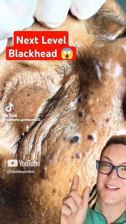 😰 Unbelievable BLACKHEADS REMOVAL #shorts - YouTube