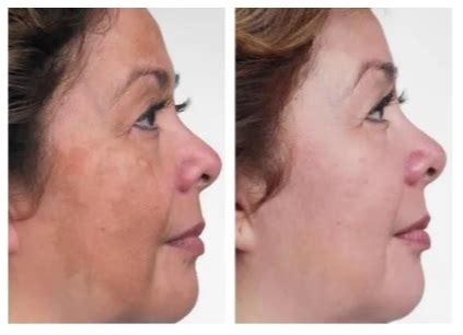 Ácido Retinoico Hidroquinona Antes E Depois - Hidroquinona Antes Depois Kit Ácido Retinóico E Hidroquinona