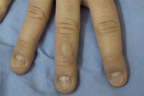 First Degree Burn Blister