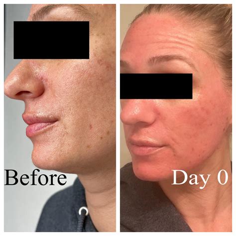 Skin Resurfacing in Alamo, CA - SculptME Med Spa