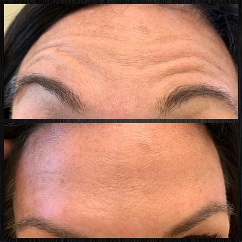 Botox, Daxxify, Dysport, Jeuveau | Before and After |Ann Arbor