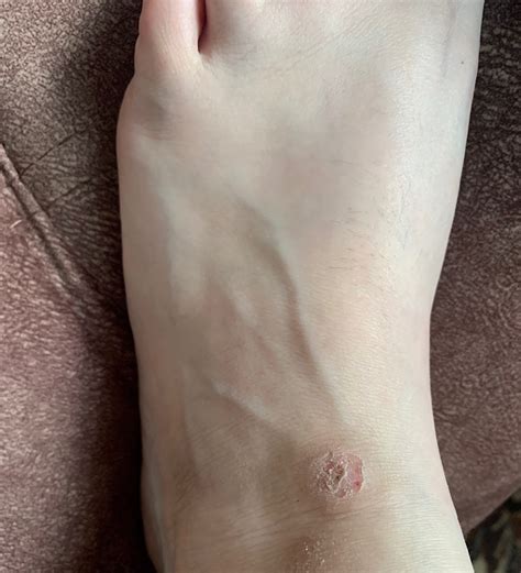 Болячка на ноге SOS - Вопрос дерматологу - 03 Онлайн