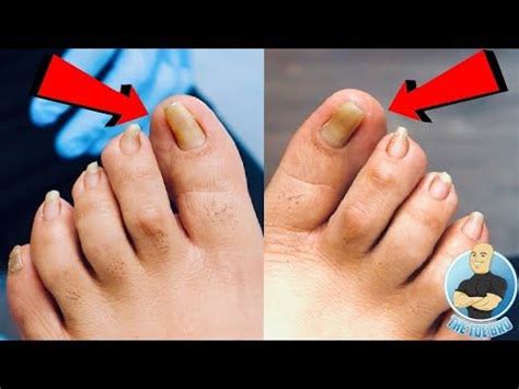 Pincer perfect toenails fixing curved nail shape without surgery – Artofit
