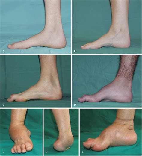 charcot-marie-tooth disease treatment Charcot tooth disease marie ...