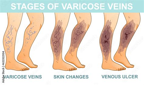 human legs  health problems varicose veins stages  vein disease