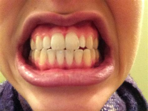 Does Oil Pulling Work To Whiten Your Teeth? I Tried It For a Week, and