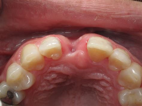 how to treat sore roof of mouth 6