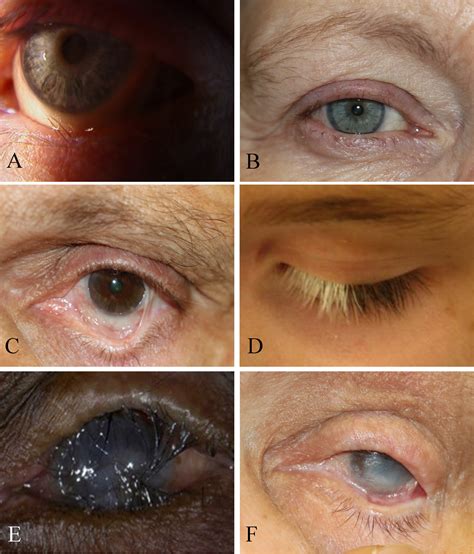 Ocular Cicatricial Pemphigoid Ocp Background GSLS OCP Research Poster