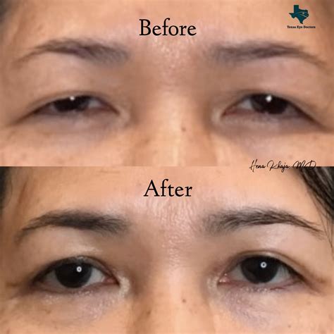 Eyelid Surgery - McKinney, TX: Texas Eye Doctors: Comprehensive Ophthalmology