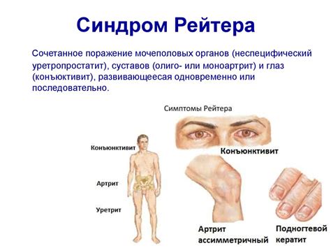 Схема лечения хламидиоза: препараты, длительность, эффективность.