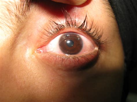 ICL Surgery Complications: What To Expect And Ways To Manage