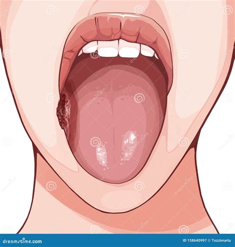 Squamous Cell Carcinoma Cartoon Vector | CartoonDealer.com #47991033