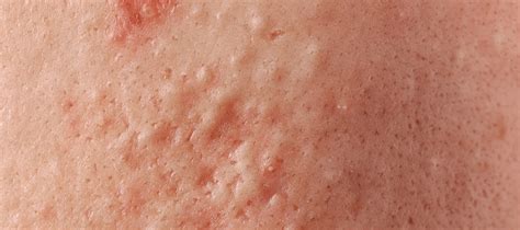 ultimate guide  comedones  face   treatments