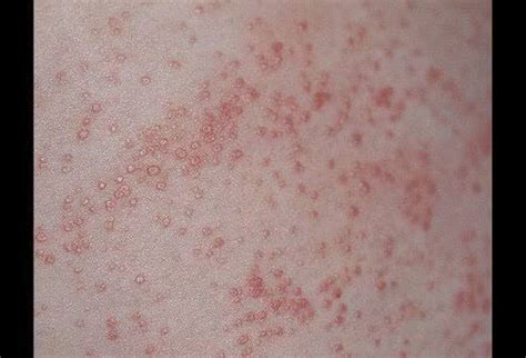 miliaria rubra  prickly heat  sweat rash medizzy
