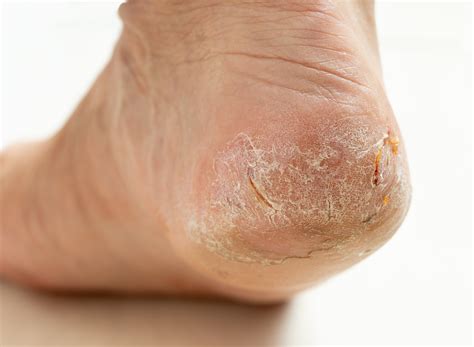 How to Heal Cracked Heels Quickly - NatraCure