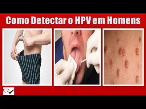 Sintomas Do Hpv No Homem