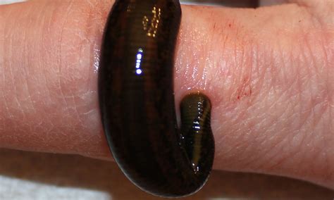 Leech Therapy