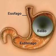 Dr. Renato Souza | Tecnologia & Cirurgia | Balão Intragástrico