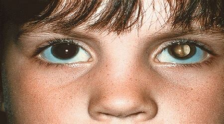 ResuMED de Tumores Oculares Malignos: características e mais!