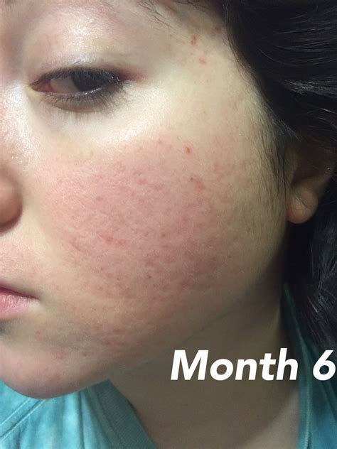 End of accutane with pics, side effects, and what i used – Accutane