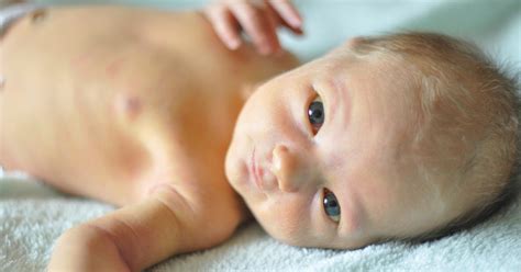 Equiterisia Em Bebe - Olhos De Bebe Com Ictericia