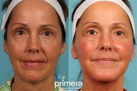 mini facelift  full facelift  procedure