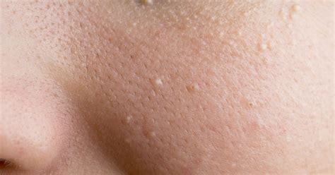 What Are Those Little White Bumps on Your Skin? They're Milia and Here ...