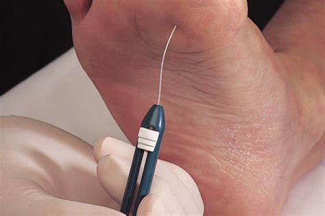 Diabetic Foot Assessment