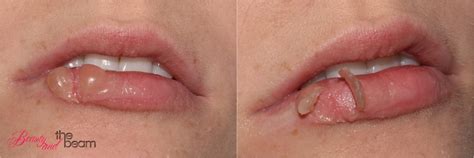 how to take care of busted lip