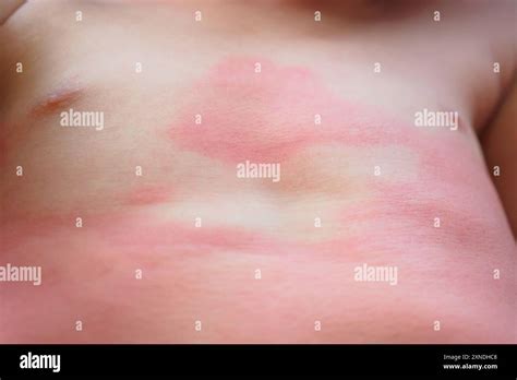 Severe eczema skin rash and allergic reaction symtom at little asian ...
