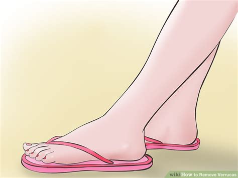 5 Ways to Remove Verrucas - wikiHow