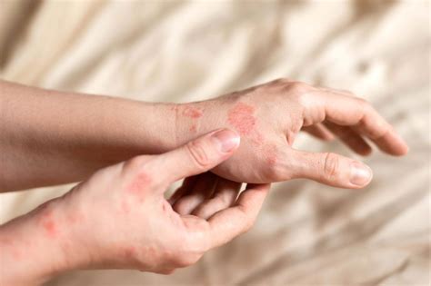Erupção Cutânea O Que É - Erupção cutânea: o que é, sintomas, causas e tratamento - Tua Saúde