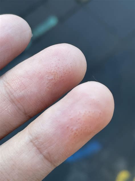 Water Bubbles Under Skin at Mitchell Cushing blog