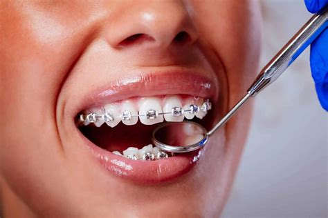 Should Your Teenager Get Braces to Achieve the Perfect Smile