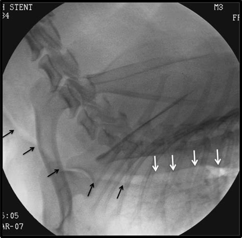 Advanced tracheal collapse