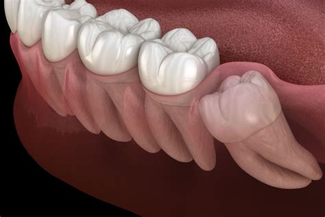 After Having A Wisdom Tooth Removal, Can Complications Occur? | The ...