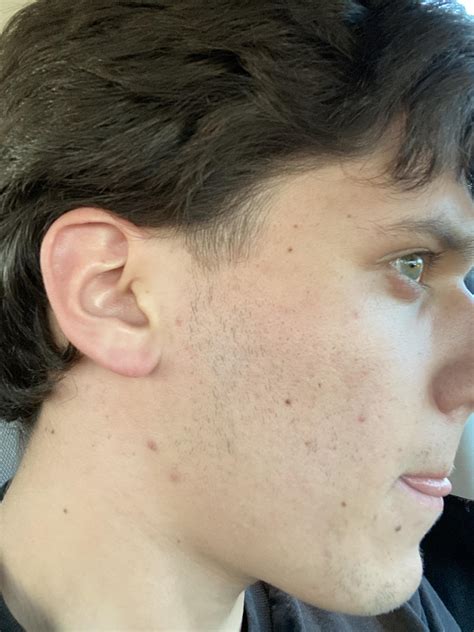 Accidentally shaved my side burns too high. Buzz my hair or let it grow