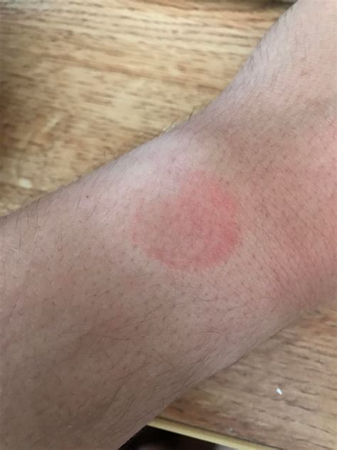 Apple Watch Irritation : r/AppleWatch