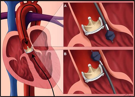 Percutaneous Approach to Mechanical Aortic Valve Prosthesis