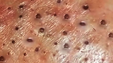 Dr pimple popper blackhead extraction pops at william frazier blog