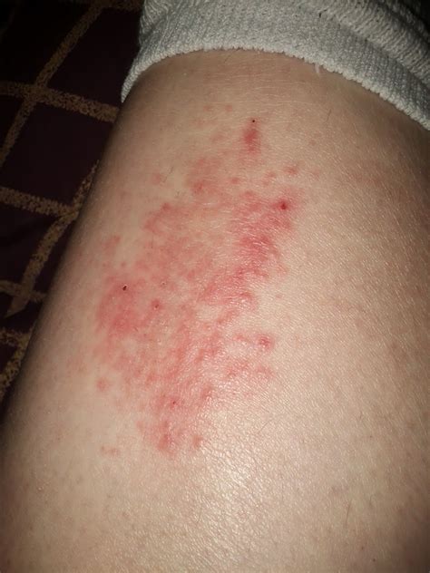 Leg Rash On Shin at Shirley Pierson blog