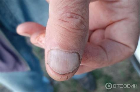 Отзыв о Противогрибковый препарат Sandoz Экзодерил | Наглядный ...