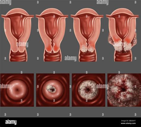 Cancer of the cervix hi-res stock photography and images - Alamy